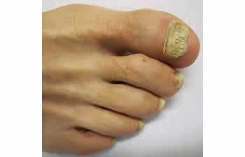 Foot with corns and calluses