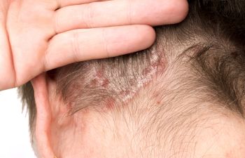 Symptoms and Causes of Persistant Scalp Itching | Atlanta, GA