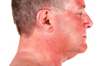 Side Profile of Male Patient with Eczema Atlanta GA