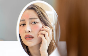 asian women are worried about faces with rosacea