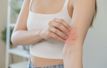 allergic reaction on young woman skin