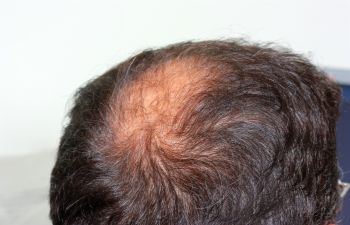 Atlanta GA Dermatologists that Treat Hair Loss