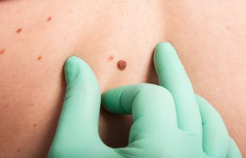 Skin Mole Beign Inspected By Doctor