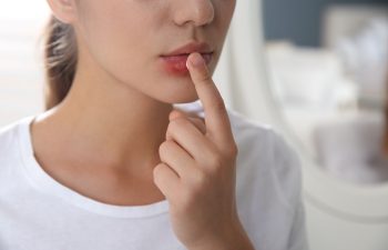 Woman with herpes applying cream on lips against blurred background, closeup