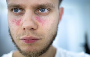 age spots of redness on the face, a young man is sick systemic lupus erythematosus